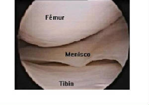 menis.jpg